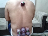 Boyun Fıtığına Sülük Tedavisi Boyun Fıtığına Sülük Tedavisi