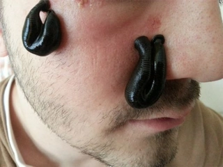 Sivilcelere Sülük Tedavisi Sivilcelere Sülük Tedavisi